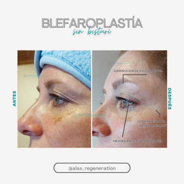 Blefaroplastia no quirúrgica