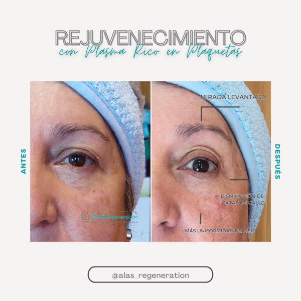 Plasma Rico en Plaquetas Facial (PRP)